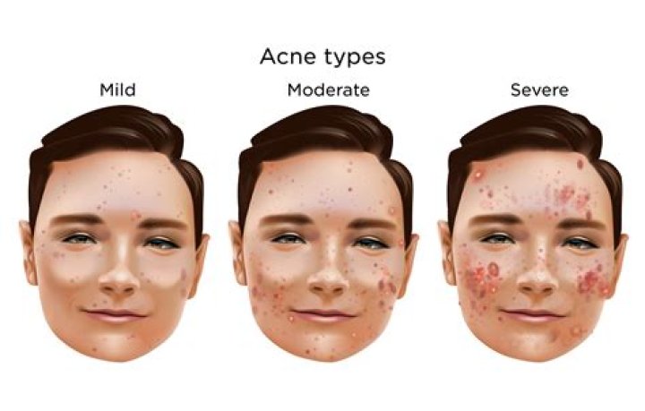acne