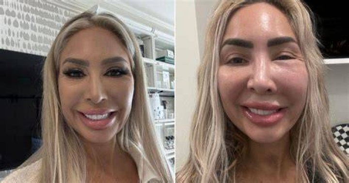 Farrah Abraham Botched Surgery