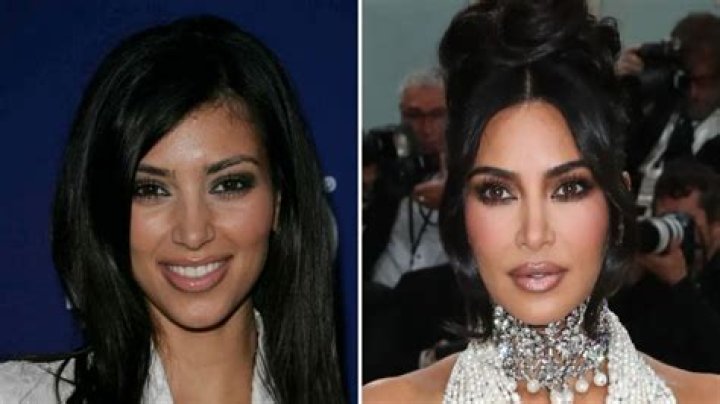 Kim Kardashian Plastic Surgery