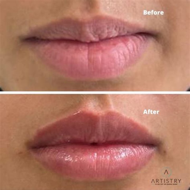 lip